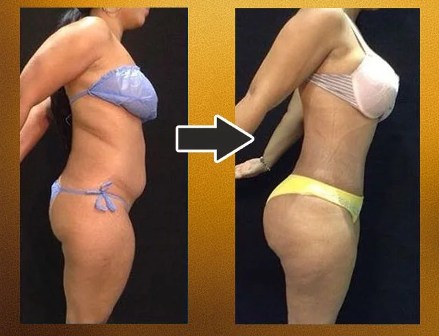 Lipoabdominoplastia com enxerto nos glúteos — caso 7. CASO7-2