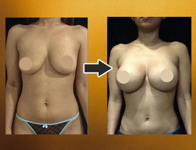 Aumento das mamas com implantes — caso 6. CASO6-2