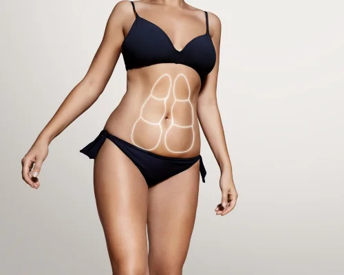Lipoaspiração