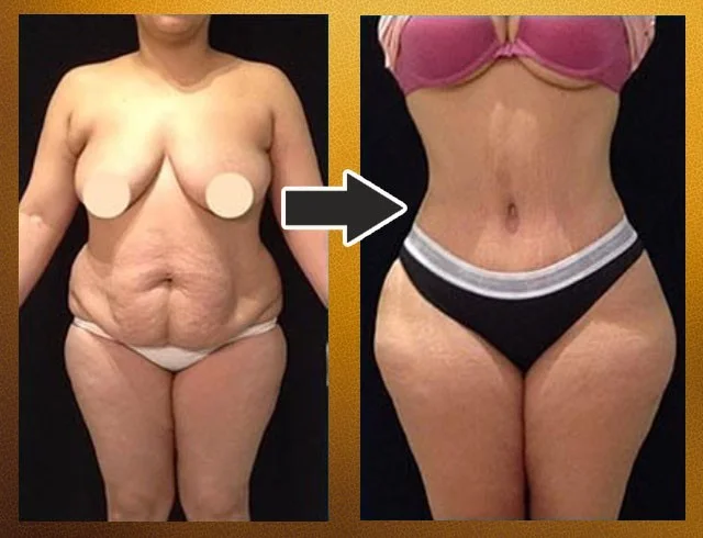Lipoabdominoplastia com enxerto nos glúteos — caso 8. CASO8-3
