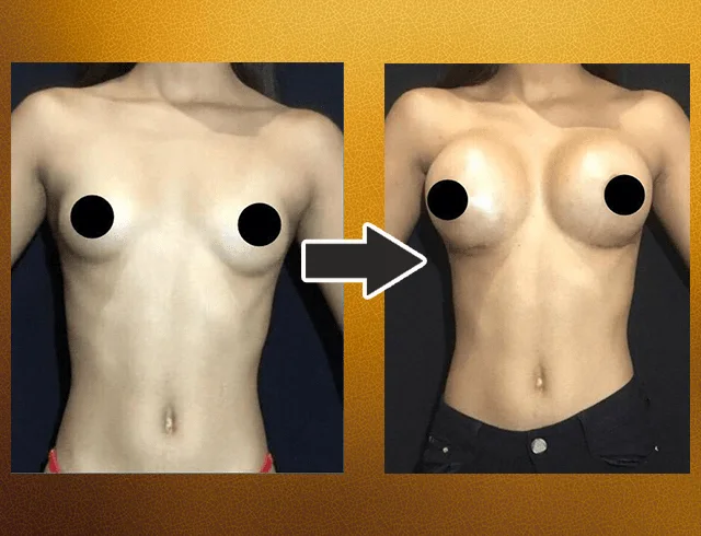 Aumento das mamas com implantes — caso 2. CASO2-2