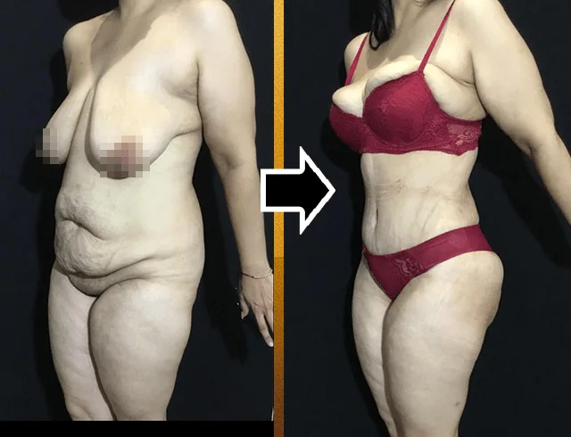 Lipoabdominoplastia com enxerto nos glúteos — caso 2. CASO2-2