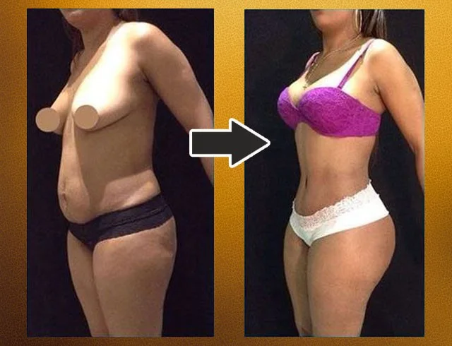 Lipoabdominoplastia com enxerto nos glúteos — caso 4. CASO4-2