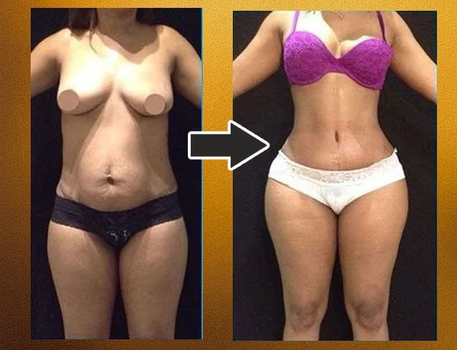 Lipoabdominoplastia com enxerto nos glúteos — caso 4. CASO4-3