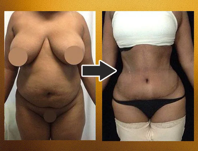 Lipoabdominoplastia com enxerto nos glúteos — caso 5. CASO5-2