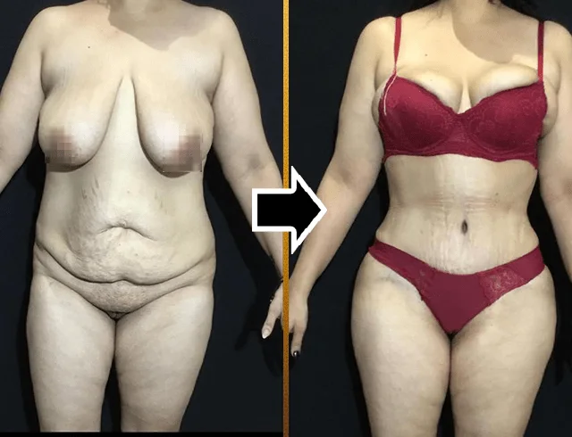 Lipoabdominoplastia com enxerto nos glúteos — caso 2. CASO2-3
