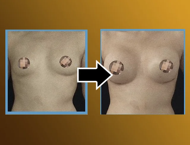 Aumento das mamas com implantes — caso 5. CASO5-2
