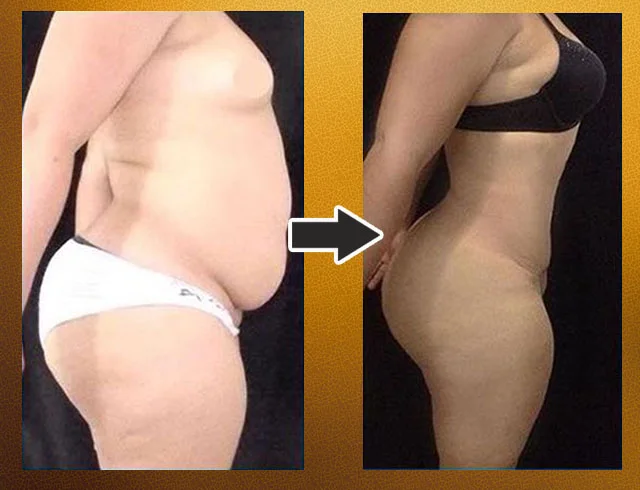 Lipoabdominoplastia com enxerto nos glúteos — caso 6. CASO6-1