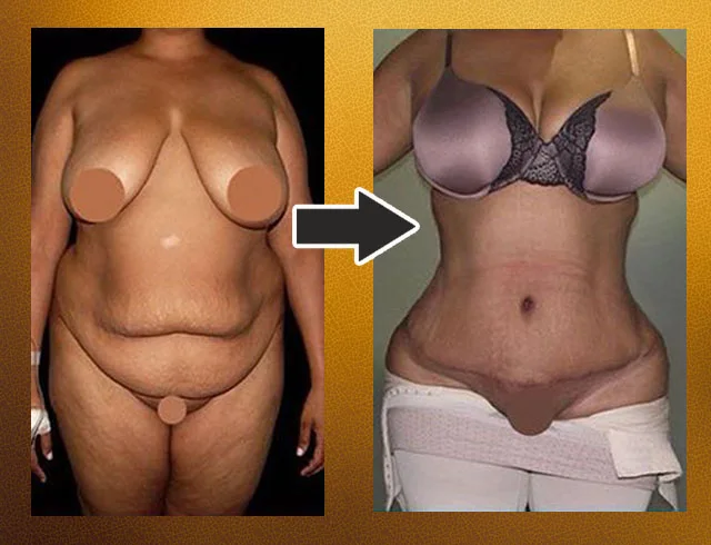 Lipoabdominoplastia com enxerto nos glúteos — caso 3. CASO3-2