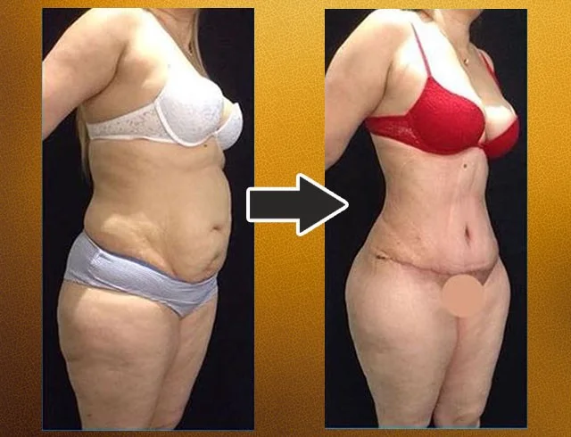Lipoabdominoplastia com enxerto nos glúteos — caso 9. CASO9-2