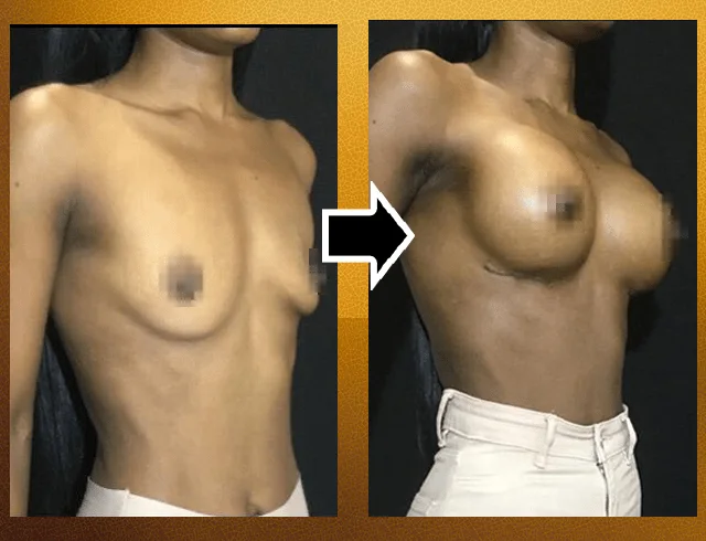 Aumento das mamas com implantes — caso 1. CASO1-2