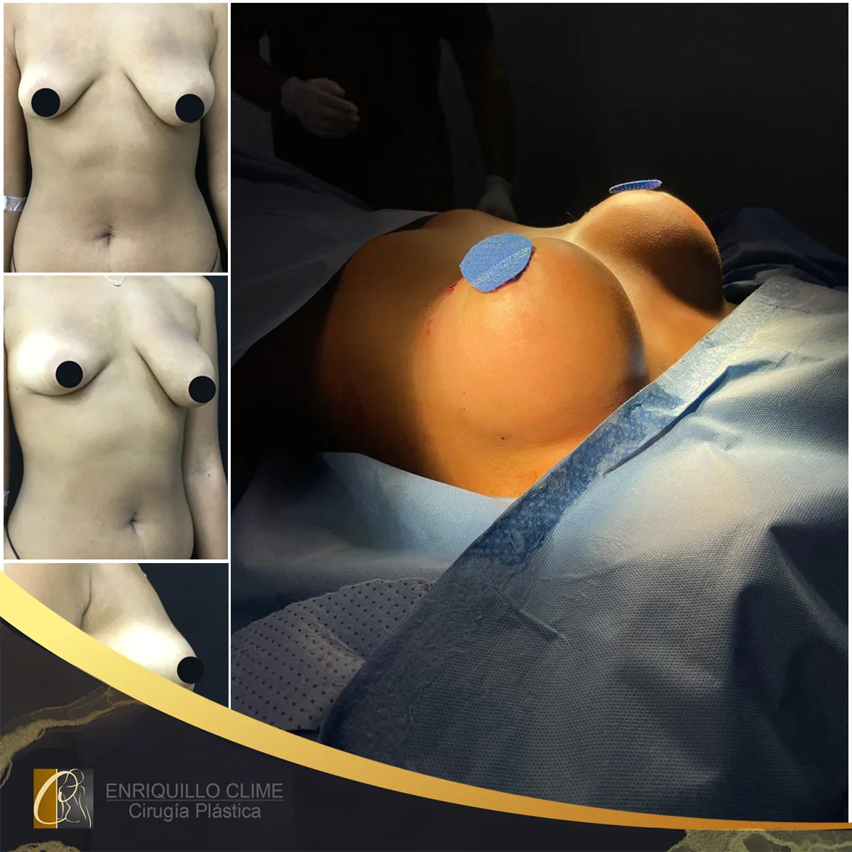 Aumento das mamas com implantes — caso 8. CASO #8