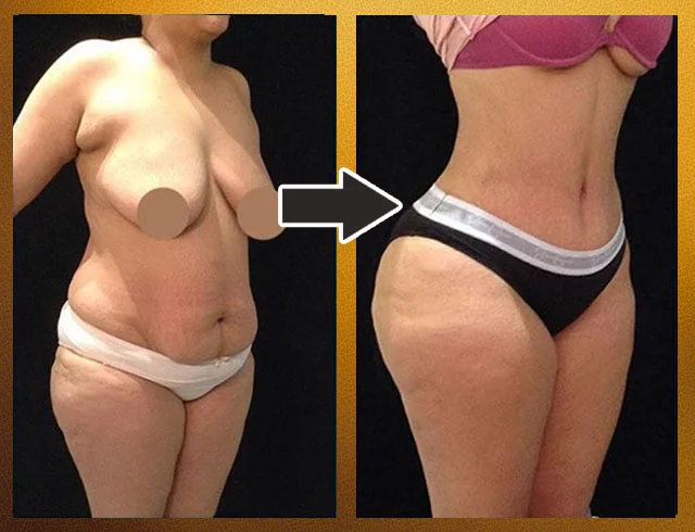 Lipoabdominoplastia com enxerto nos glúteos — caso 8. CASO8-2