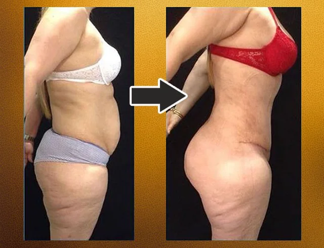 Lipoabdominoplastia com enxerto nos glúteos — caso 9. CASO9-1