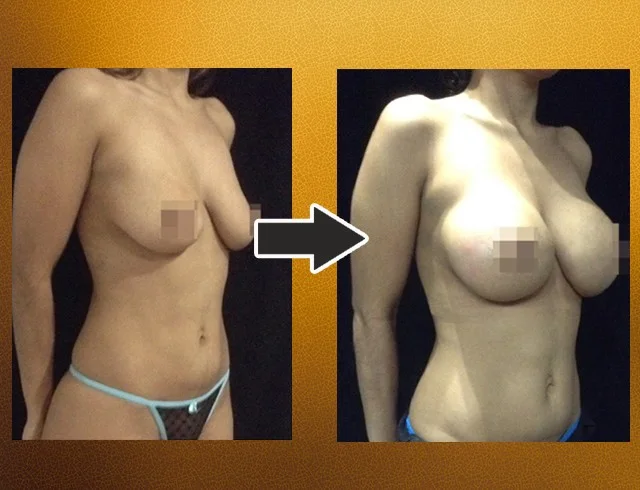 Aumento das mamas com implantes — caso 6. CASO6-1
