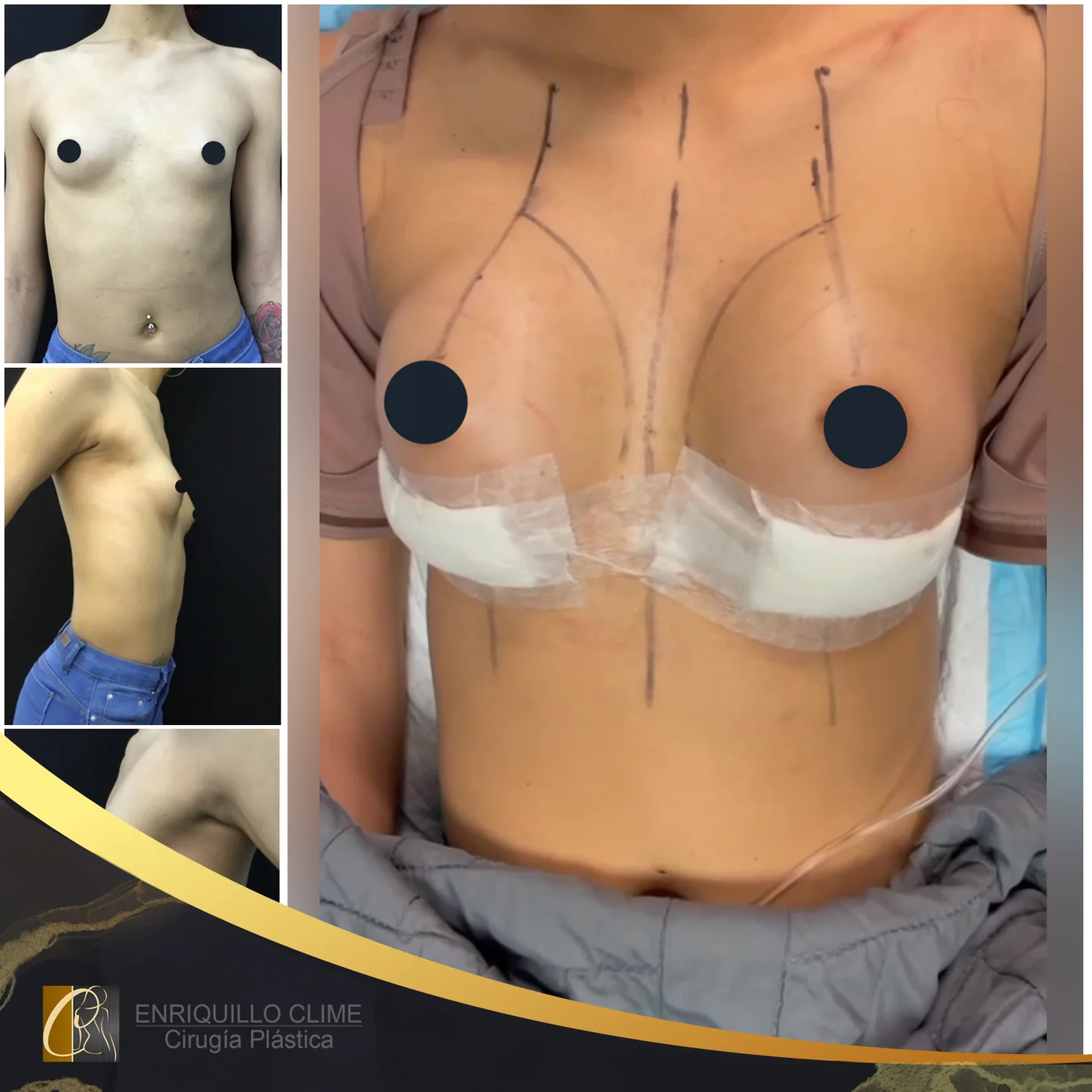 Aumento das mamas com implantes — caso 10. CASO #10