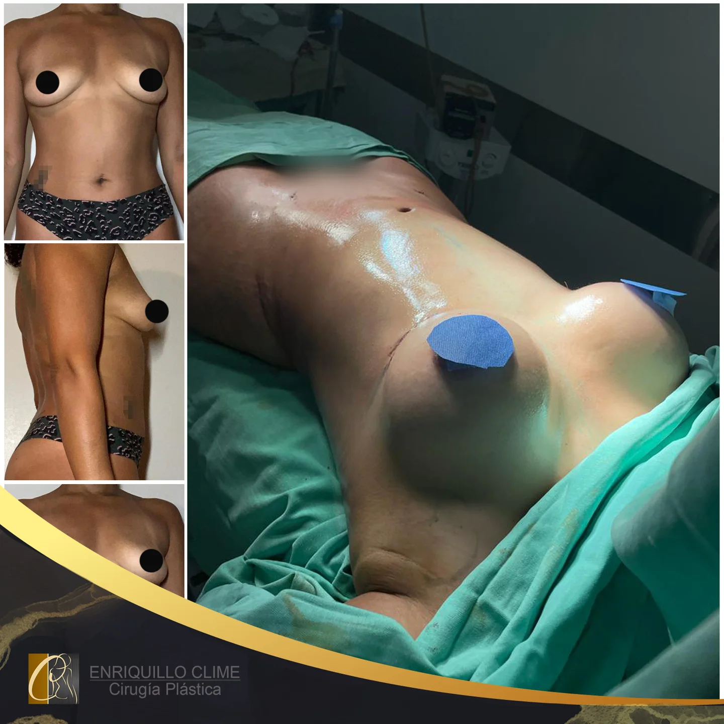 Aumento das mamas com implantes — caso 9. CASO #9