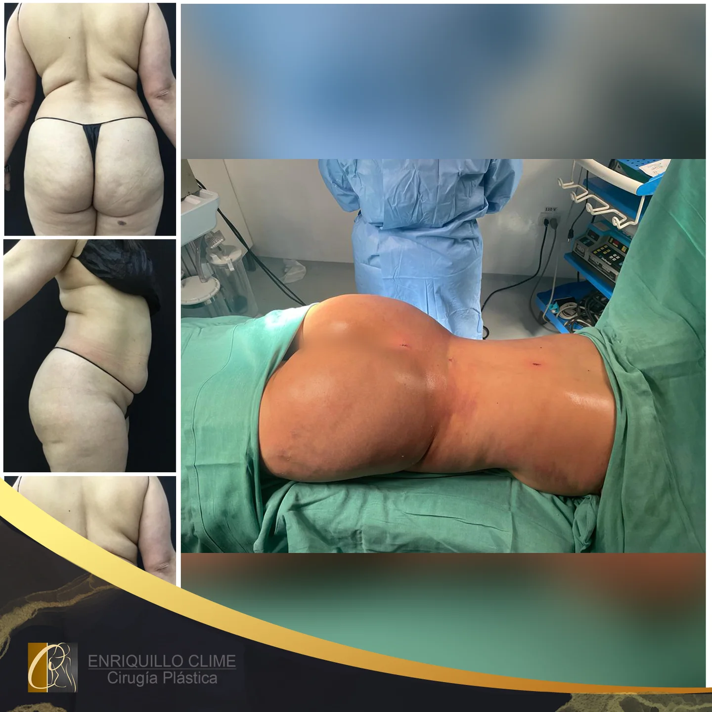 Lifting brasileiro de glúteos BBL — caso 9. CASO #9
