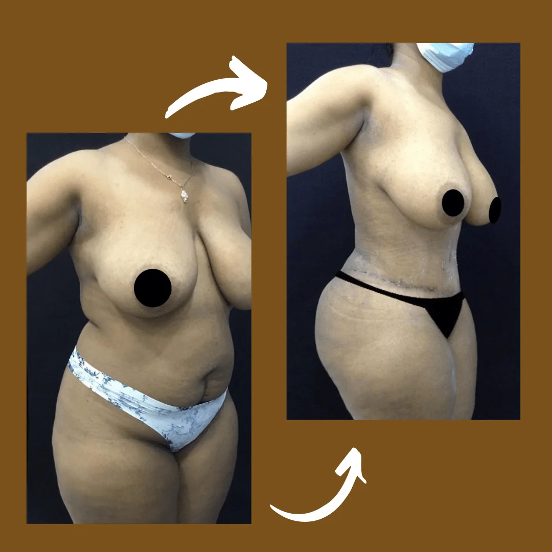 Lipoabdominoplastia com enxerto nos glúteos — caso 1. CASO1-1