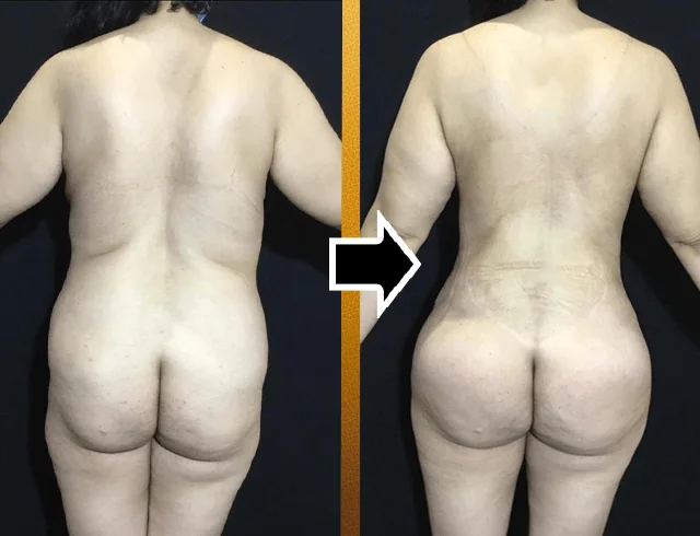 Lipoabdominoplastia com enxerto nos glúteos — caso 2. CASO2-1