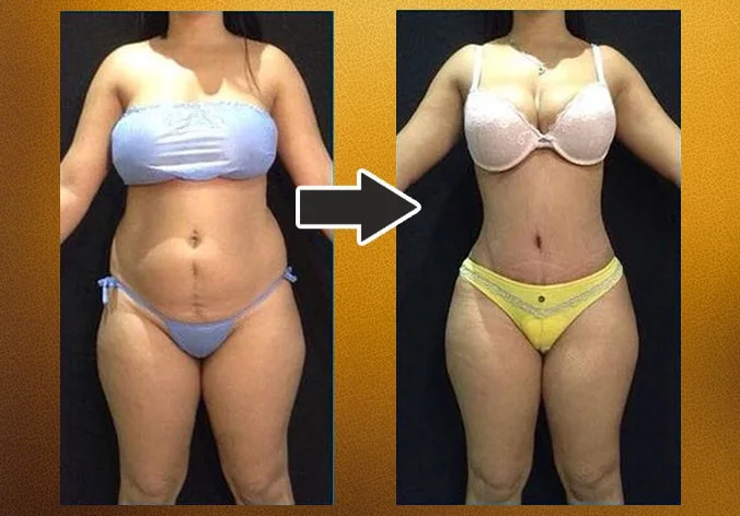 Lipoabdominoplastia com enxerto nos glúteos — caso 7. CASO7-3