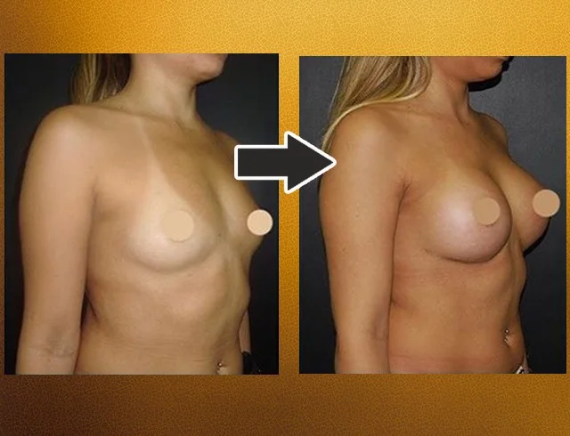 Aumento das mamas com implantes — caso 7. CASO7-2