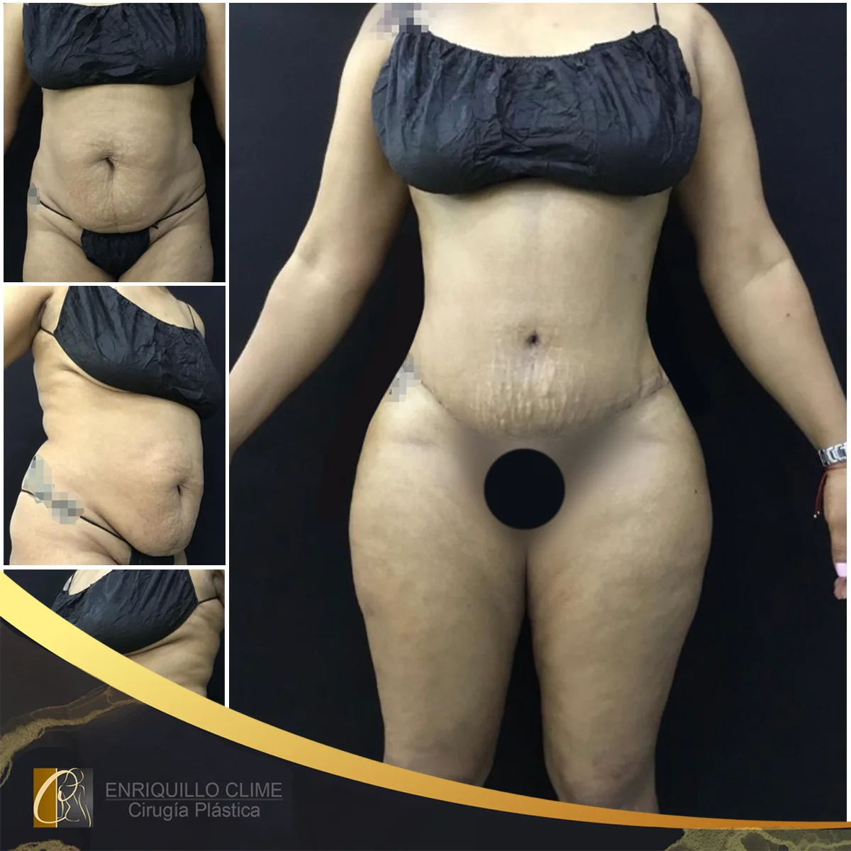 Lipoabdominoplastia com enxerto nos glúteos — caso 11. CASO #11