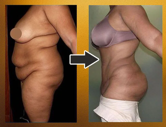 Lipoabdominoplastia com enxerto nos glúteos — caso 3. CASO3-1