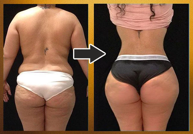 Lipoabdominoplastia com enxerto nos glúteos — caso 8. CASO8-1