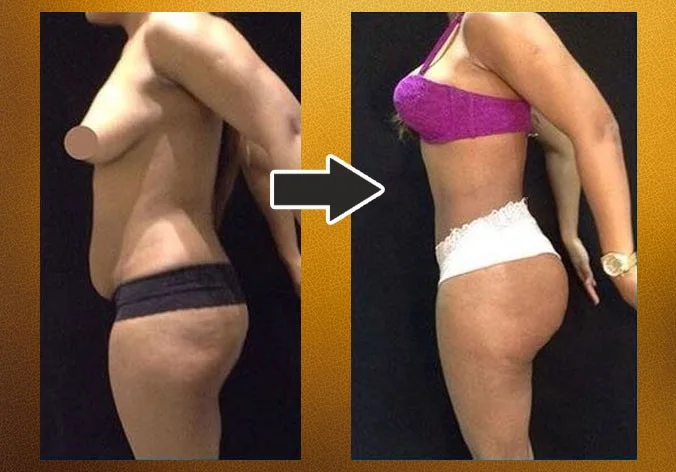 Lipoabdominoplastia com enxerto nos glúteos — caso 4. CASO4-1