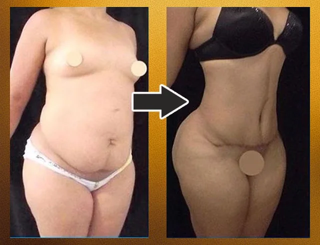 Lipoabdominoplastia com enxerto nos glúteos — caso 6. CASO6-2
