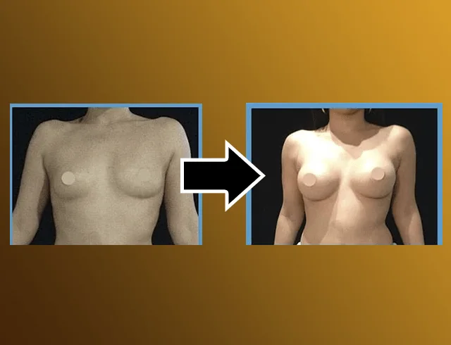 Aumento das mamas com implantes — caso 3. CASO3-2