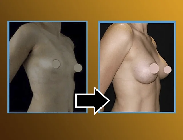 Aumento das mamas com implantes — caso 5. CASO5-1