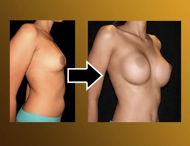 Aumento das mamas com implantes — caso 4. CASO4-2