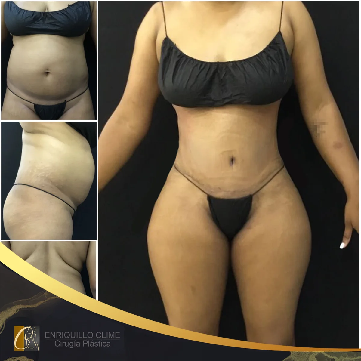 Lipoabdominoplastia com enxerto nos glúteos — caso 10. CASO #10