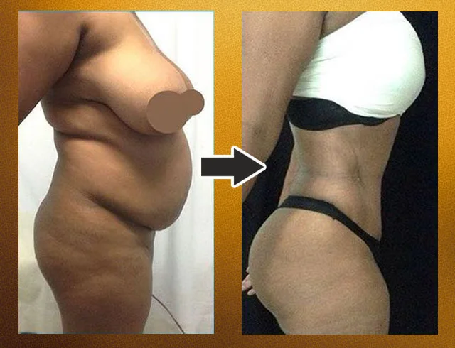 Lipoabdominoplastia com enxerto nos glúteos — caso 5. CASO5-1