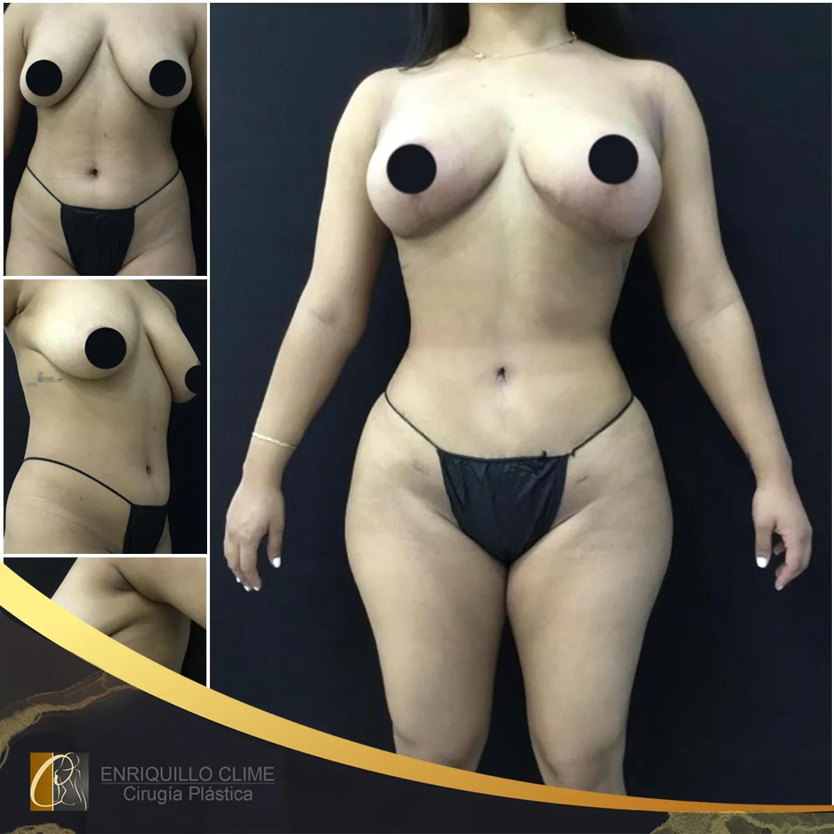 Lifting das mamas — caso 8. CASO #8