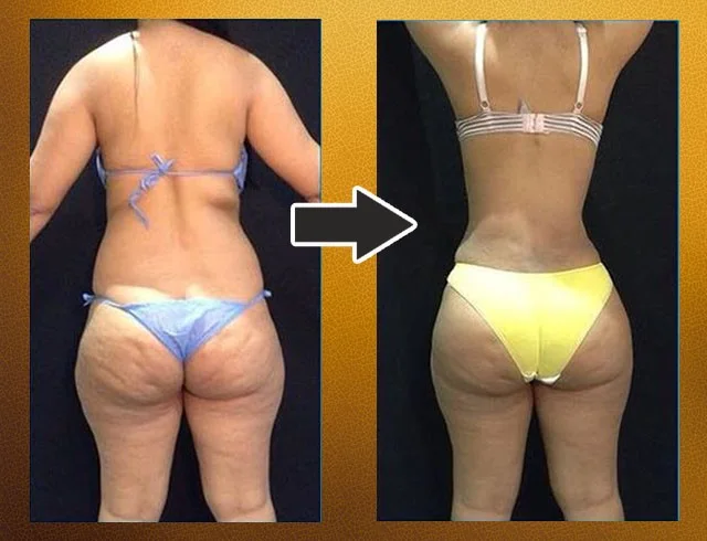 Lipoabdominoplastia com enxerto nos glúteos — caso 7. CASO7-1