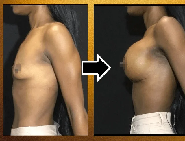 Aumento das mamas com implantes — caso 1. CASO1-1