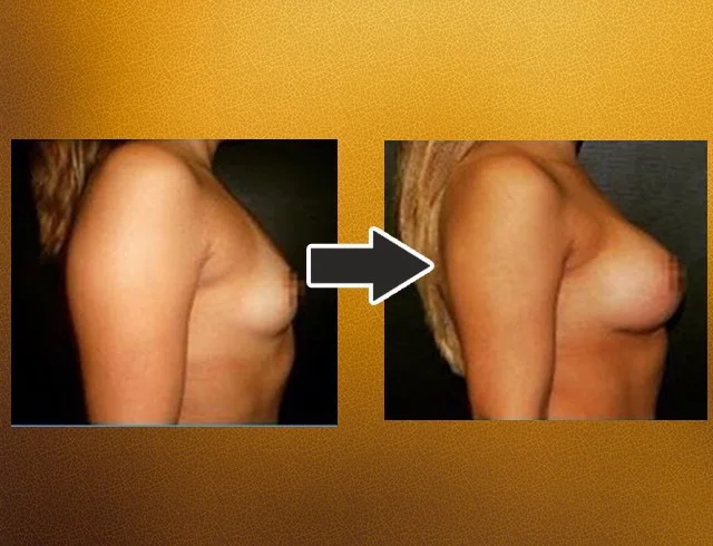 Aumento das mamas com implantes — caso 7. CASO7-1