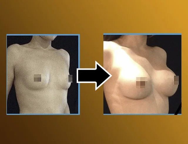 Aumento das mamas com implantes — caso 3. CASO3-1