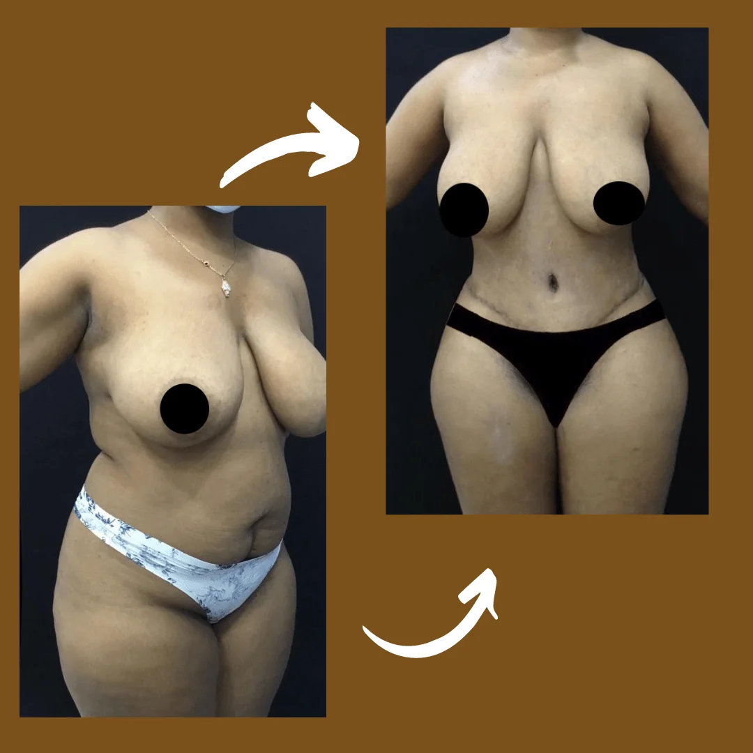 Lipoabdominoplastia com enxerto nos glúteos — caso 1. CASO1-2