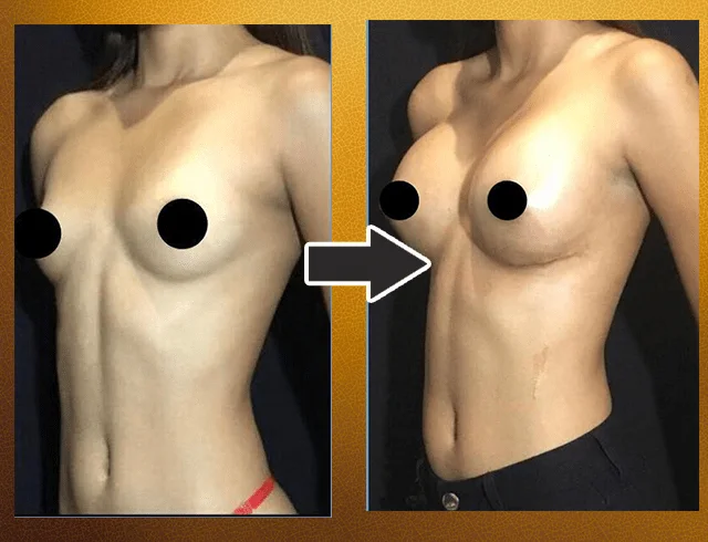 Aumento das mamas com implantes — caso 2. CASO2-1